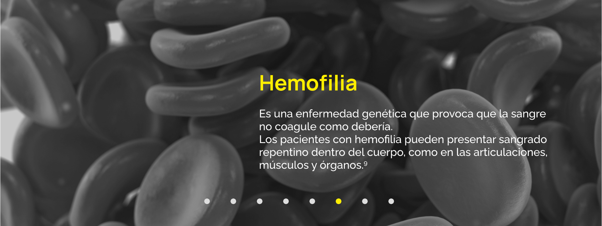 Es una enfermedad genética que provoca que la sangre no coagule como debería. Los pacientes con Hemofilia pueden presentar sangrado repentino dentro del cuerpo, como en las articulaciones, músculos y órganos.9